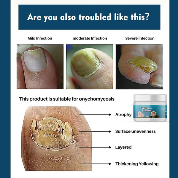 Nail Fungus Ointment 200 gm Pack of 2