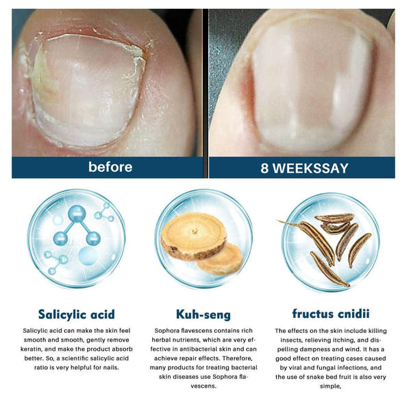 Nail Fungus Ointment 200 gm Pack of 2