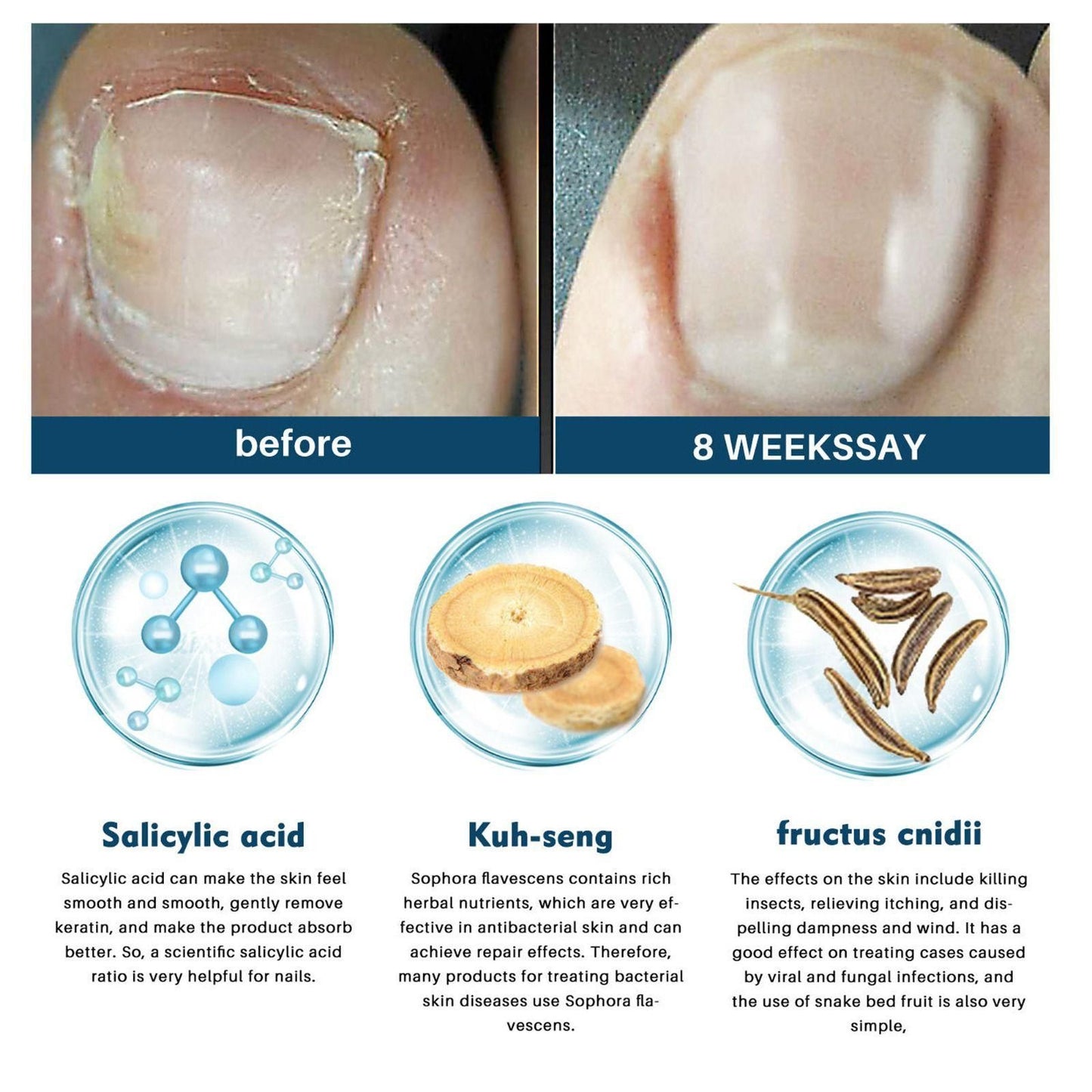 Nail Fungus Ointment 200 gm Pack of 2