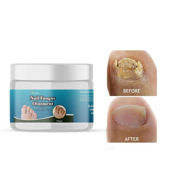 Nail Fungus Ointment 200 gm Pack of 2